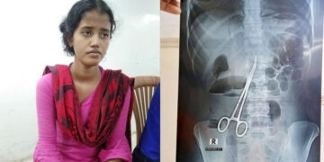 পেটে কাঁচি রেখেই সেলাই, ৬৪৩ দিন পর অপসারণ