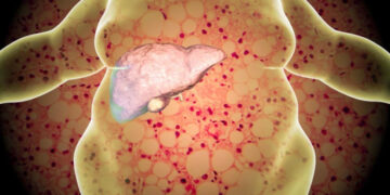 ফ্যাটি লিভারে আক্রান্তদের যে ভুলে অকেজো হতে পারে লিভার