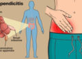 পাত্তা না দিলে ভয়ঙ্কর রূপ নেয় অ্যাপেন্ডিসাইটিস