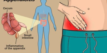 পাত্তা না দিলে ভয়ঙ্কর রূপ নেয় অ্যাপেন্ডিসাইটিস