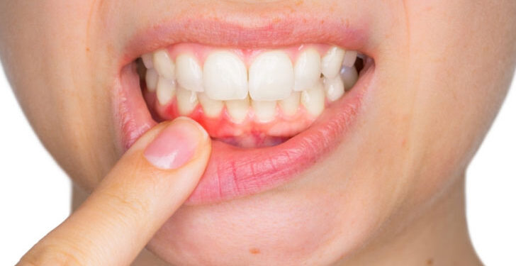 কীভাবে মাড়ির রক্তক্ষরণ প্রতিরোধ করবেন ?