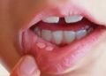মুখের ভেতরে ছাল উঠে গেলে করণীয়