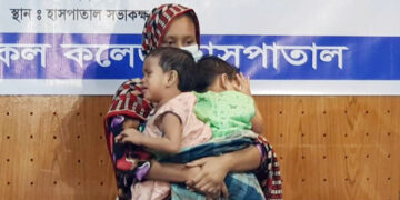 জোড়া শিশু লাবিবা-লামিসার অস্ত্রোপচার সোমবার