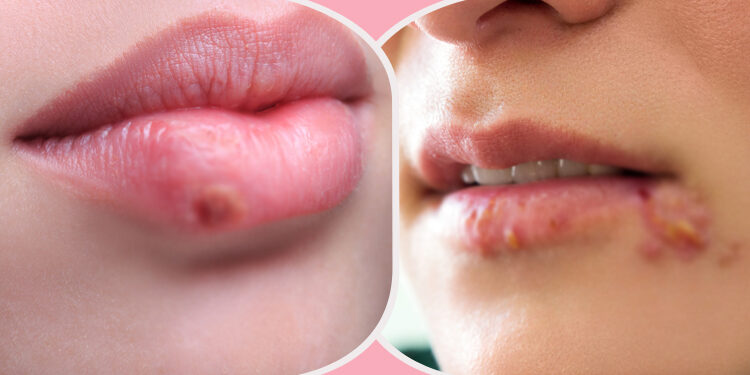 শীতে ঠোঁটের পাশে জ্বর-ঠোসা উঠলে যা করবেন-