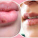 শীতে ঠোঁটের পাশে জ্বর-ঠোসা উঠলে যা করবেন-