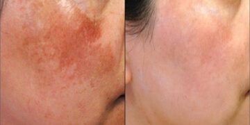 মেছতা কেন হয়, কী করবেন?