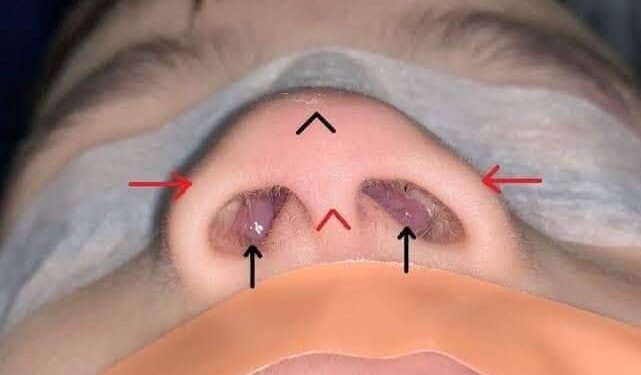 নাকের_মাংস_বেড়েছে। আসলে বিষয়টা কি?