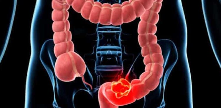 পায়ুপথের সমস্যা থেকে ক্যানসার