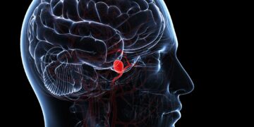 সাবএরাকনয়েড হেমোরেজ, মস্তিষ্কে রক্তক্ষরণ !