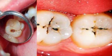 দাঁতের ক্যাভিটি থেকে মুক্তি পেতে করণীয়