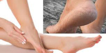 শীতে পায়ের গোড়ালি ফেটে গেলে করণীয়