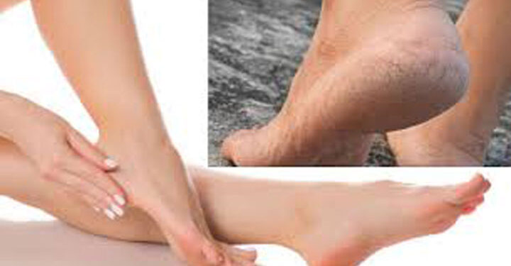 শীতে পায়ের গোড়ালি ফেটে গেলে করণীয়