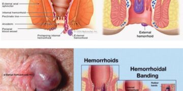 পাইলস কেন হয়, লক্ষণসমূহ