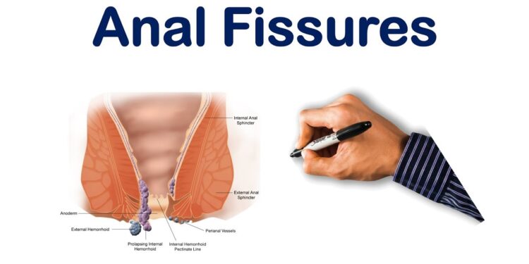 গেজ বা অ্যানাল ফিশার: লজ্জা বনাম চিকিৎসা