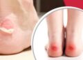 নতুন জুতো পরলে পায়ে ফোস্কা, যা করবেন