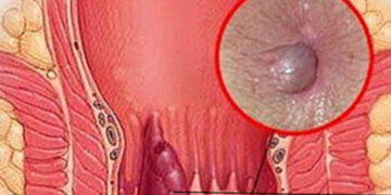 বিনা অপারেশনে ফিস্টুলার চিকিৎসা নেই