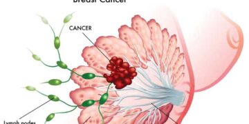 স্তন ক্যান্সারের ৩ ধরন