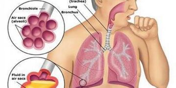 অ্যাসপিরেশন নিউমোনিয়া, প্রতিরোধ ও প্রতিকার