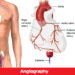 করোনারি এনজিওগ্রাম