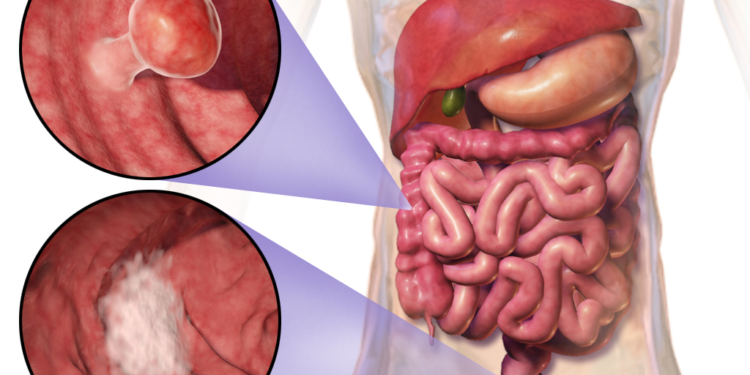 যেসব লক্ষণে বুঝবেন কোলোরেক্টাল ক্যান্সার