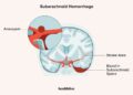 সাবএরাকনয়েড হেমোরেজ কী ?