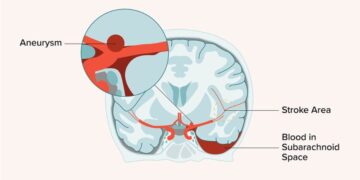 সাবএরাকনয়েড হেমোরেজ কী ?