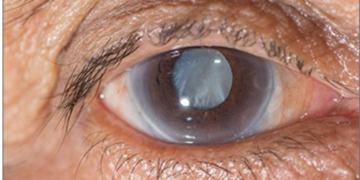 গ্লুকোমার কারণ ,লক্ষণ ও প্রতিকারের উপায়