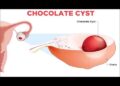 চকলেট সিস্ট নারীদের অনিরাময়যোগ্য রোগ