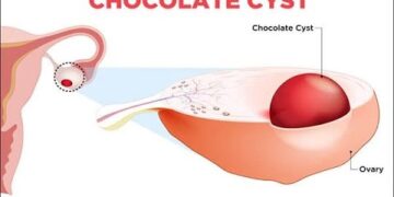চকলেট সিস্ট নারীদের অনিরাময়যোগ্য রোগ