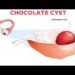 চকলেট সিস্ট নারীদের অনিরাময়যোগ্য রোগ