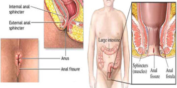 পায়ুপথের সমস্যা নিয়ে সতর্কতা