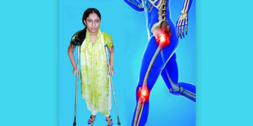 কোমর প্রতিস্থাপন কখন করাবেন, কতটা নিরাপদ?