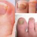 ভাঙা নখের চিকিৎসা