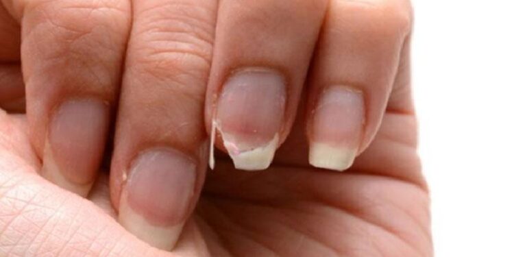 নখ ভেঙে যাওয়া থাইরয়েডের সমস্যা নয় তো?