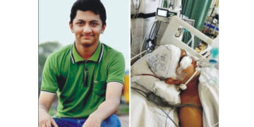 মাথার খুলির অংশ প্রতিস্থাপনে হাসপাতালে ভর্তি চমেকের আকিব