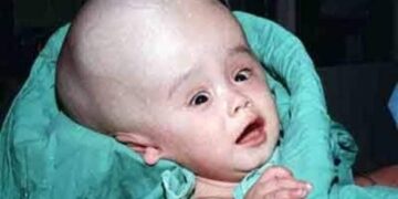 হাইড্রোকেফালাস: বড় মাথার শিশু