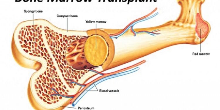 রক্তরোগের রকমফের ও অস্থিমজ্জা প্রতিস্থাপন