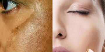 মেছতা কেন হয়, কী করবেন?