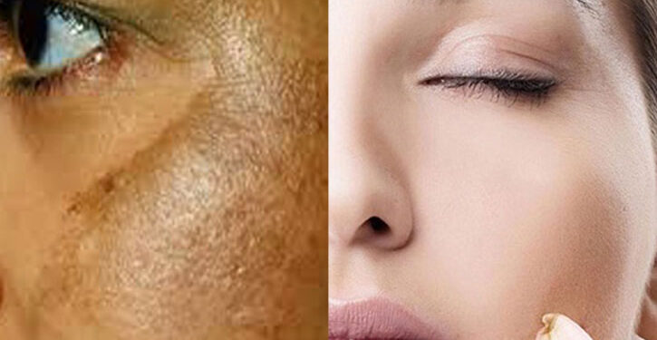 মেছতা কেন হয়, কী করবেন?