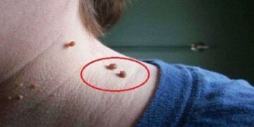 আঁচিল হলে করণীয়