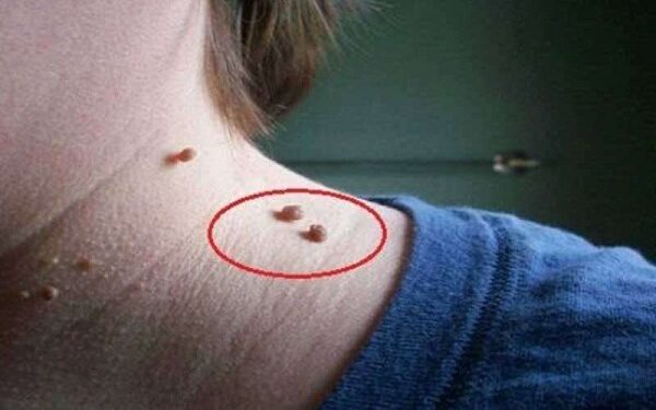 আঁচিল হলে করণীয়