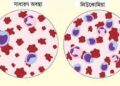 চিকিৎসায় নিরাময় সম্ভব লিউকোমিয়া