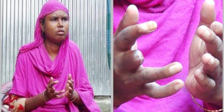 বিরল রোগ ‘সিস্টেমিক স্কেলেরোসিসে’ আক্রান্ত শরিফা, ছড়িয়ে পড়ছে সব আঙুলে