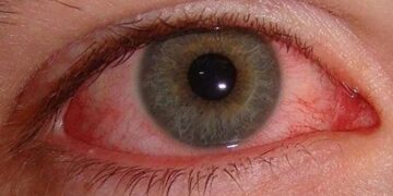 চোখের রোগে ইনজেকশন ও গ্লুকোমা রোগের জরুরি তথ্য