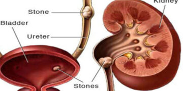 এই পরামর্শগুলো মেনে চললে কিডনির পাথর দূর করা সম্ভব
