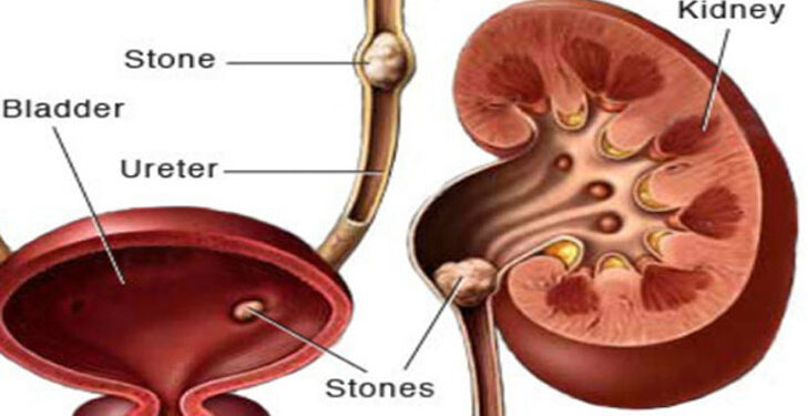 এই পরামর্শগুলো মেনে চললে কিডনির পাথর দূর করা সম্ভব