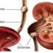 এই পরামর্শগুলো মেনে চললে কিডনির পাথর দূর করা সম্ভব