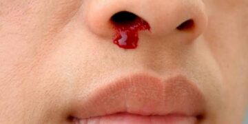 নাক দিয়ে রক্ত পড়লে কী করবেন?