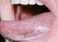 মুখের রোগ লিউকোপ্লাকিয়া