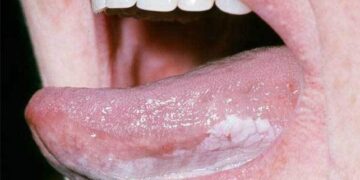 মুখের রোগ লিউকোপ্লাকিয়া